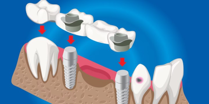 Dental Bridges in Raipur