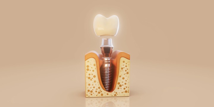 Dental Implants in Raipur