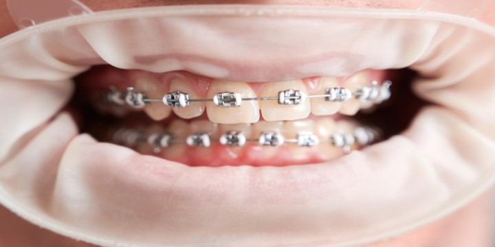 Orthodontist in Raipur