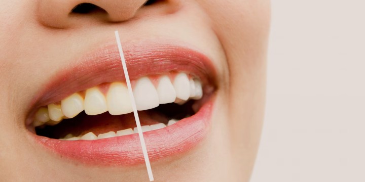 Teeth Whitening in Raipur